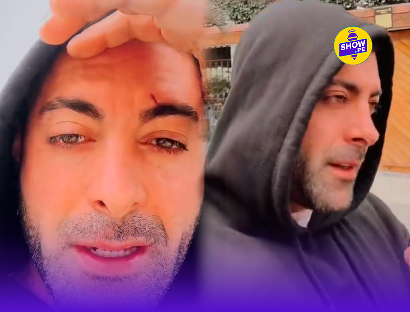 Sebastián Lizarzaburu con cicatrices en la cara